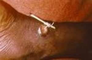 Reduction in Guinea Worm infection in Volta Region